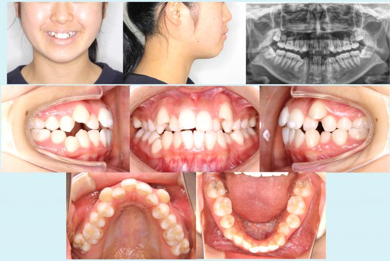 #19　1年10か月で八重歯を治療した症例