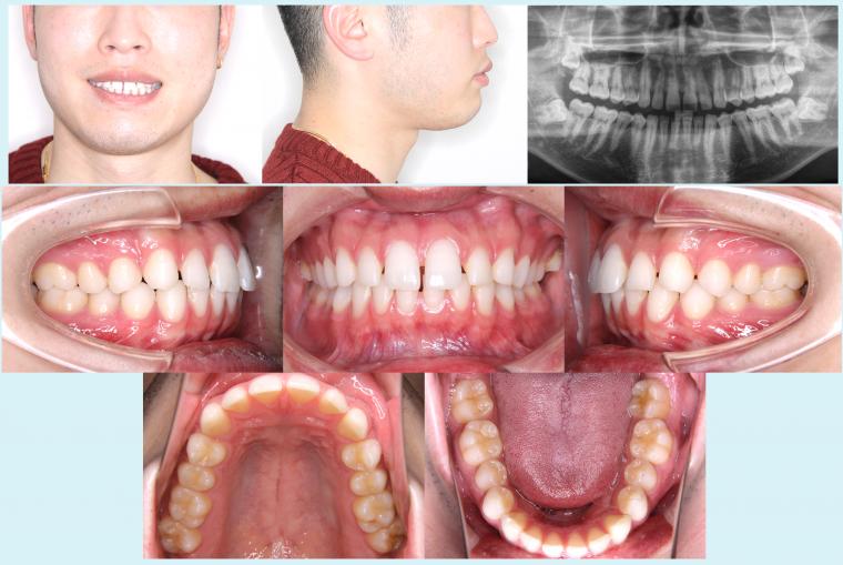#23　すきっ歯を治療した症例