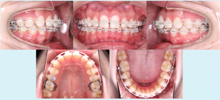 #23　すきっ歯を治療した症例