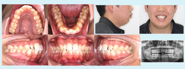 #2　上下小臼歯を4本抜歯して叢生と出っ歯を治した症例