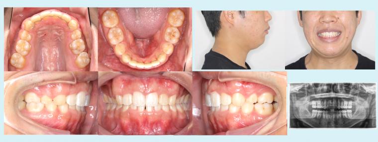 #2　上下小臼歯を4本抜歯して叢生と出っ歯を治した症例