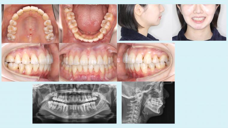 #3　小学生の時に4本抜歯した矯正の再治療を行った症例