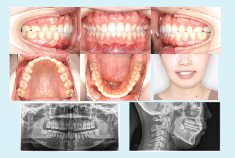 #4　前歯の深いかみ合わせを治療した症例