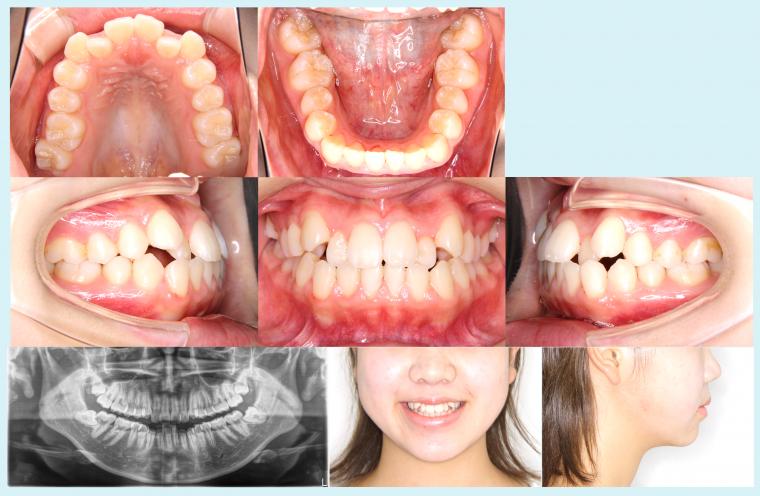 #10　上下4本の小臼歯抜歯を行って治療した症例
