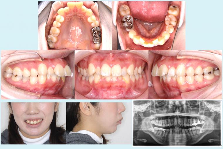 #12　出っ歯を改善したハーフリンガル症例