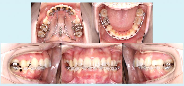 #12　出っ歯を改善したハーフリンガル症例