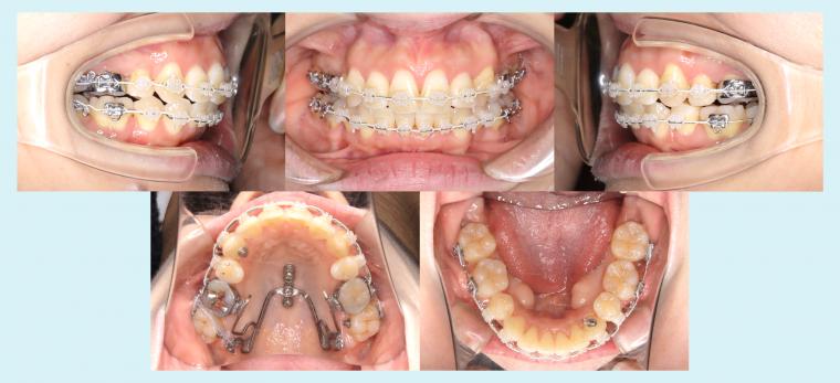 #47 アイステーションを使用した非対称症例