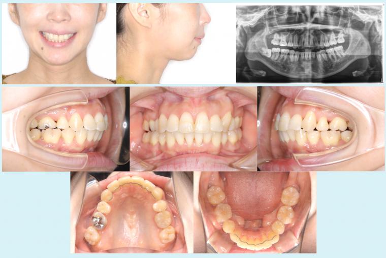 #47 アイステーションを使用した非対称症例
