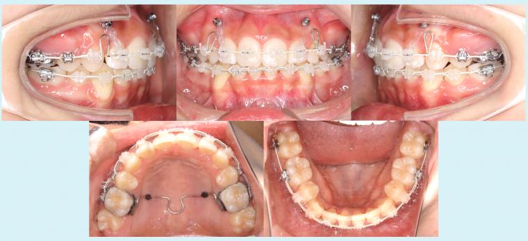 #35　表側矯正装置で八重歯を治療した症例