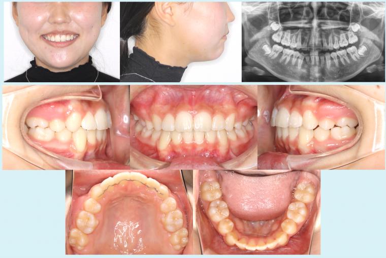 #35　表側矯正装置で八重歯を治療した症例