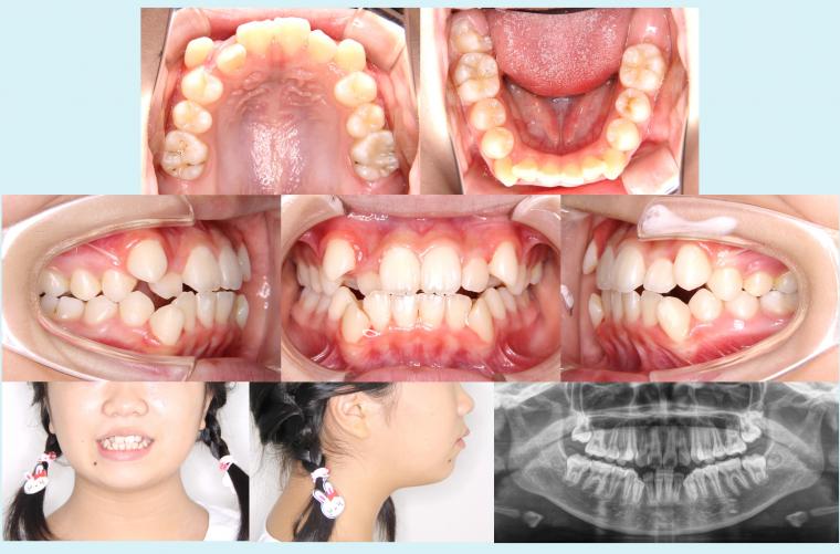 #18　抜歯を行って八重歯を治療した症例