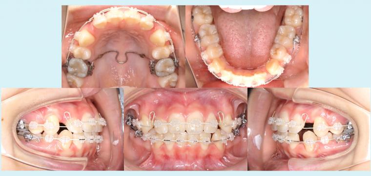 #18　抜歯を行って八重歯を治療した症例