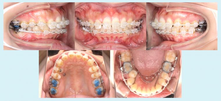 #17　小臼歯のシザースバイトを治療した症例
