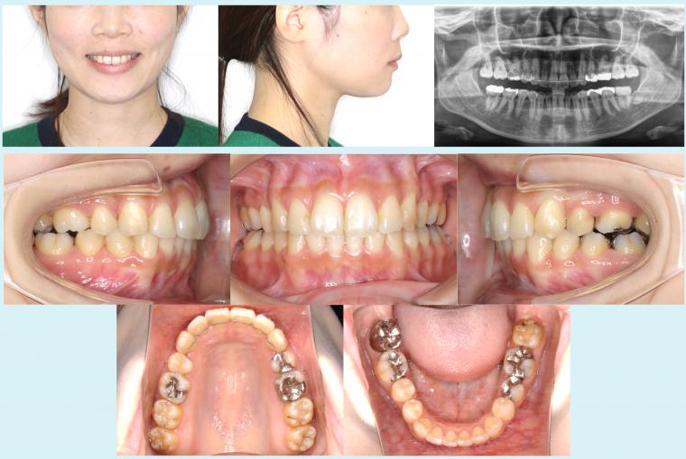 #36　上顎前突を改善したハーフリンガル症例