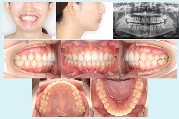 #17　小臼歯のシザースバイトを治療した症例