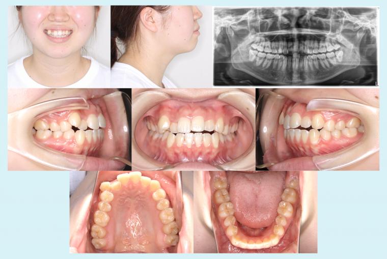 ♯48 八重歯を治療した症例