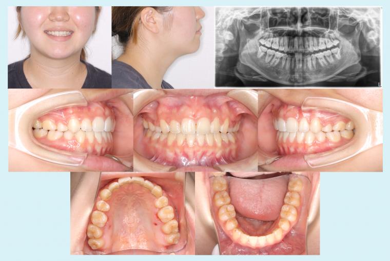 ♯48 八重歯を治療した症例
