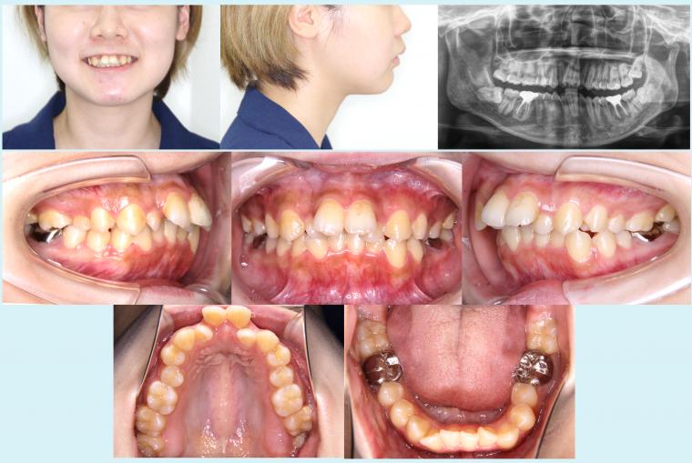 #37　上顎前突を治療した予後2年経過症例