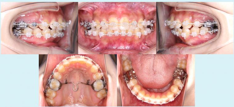 #37　上顎前突を治療した予後2年経過症例