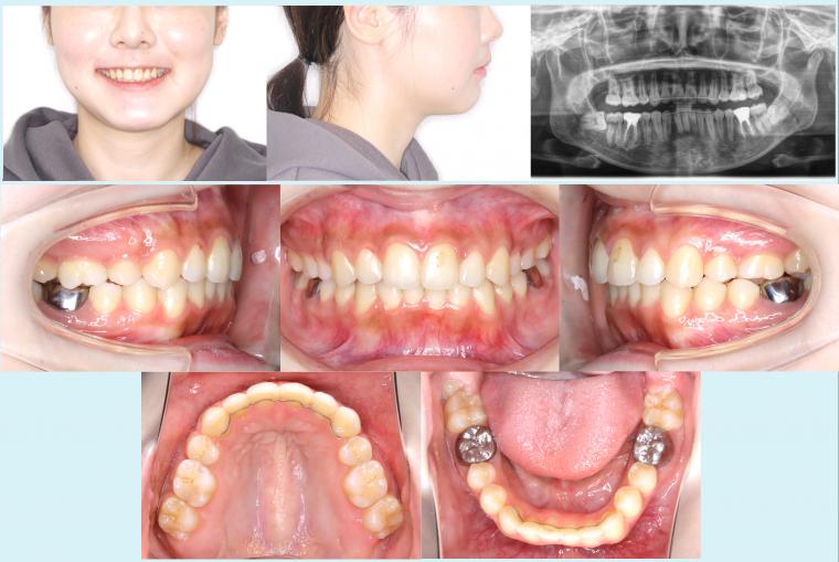 #37　上顎前突を治療した予後2年経過症例