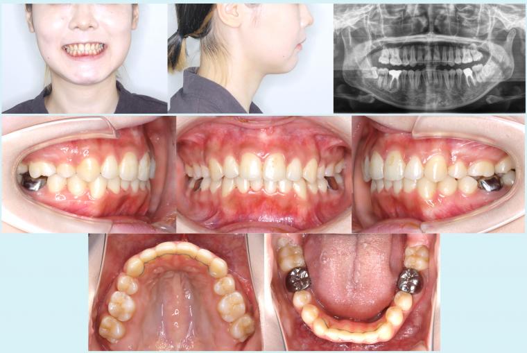 #37　上顎前突を治療した予後2年経過症例