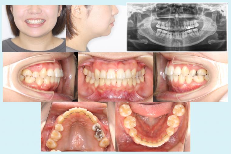 #49 重度叢生症例