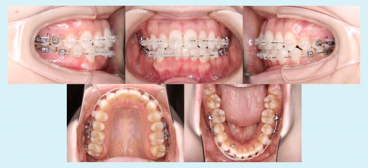 #50　非抜歯で叢生を改善した症例