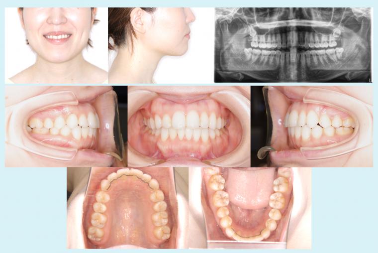 #50　非抜歯で叢生を改善した症例