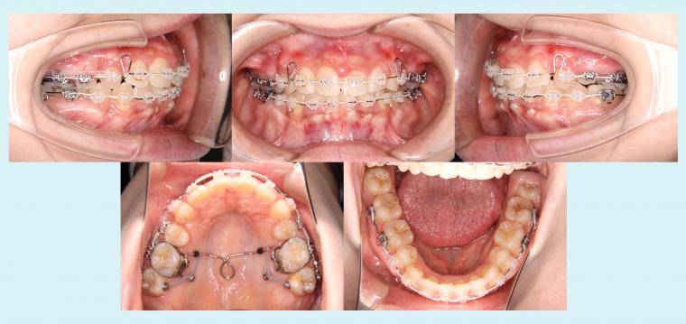 #51　矯正用インプラントアンカーを用いてオートローテーションを図った症例