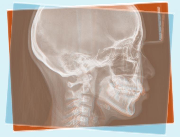 #51　矯正用インプラントアンカーを用いてオートローテーションを図った症例