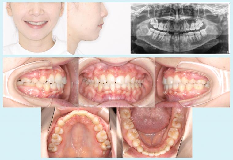 #51　矯正用インプラントアンカーを用いてオートローテーションを図った症例
