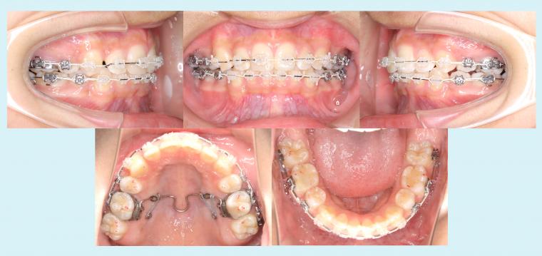 #52　13歳4か月から上顎前突の治療を行った症例