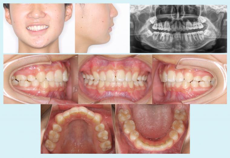#52　13歳4か月から上顎前突の治療を行った症例