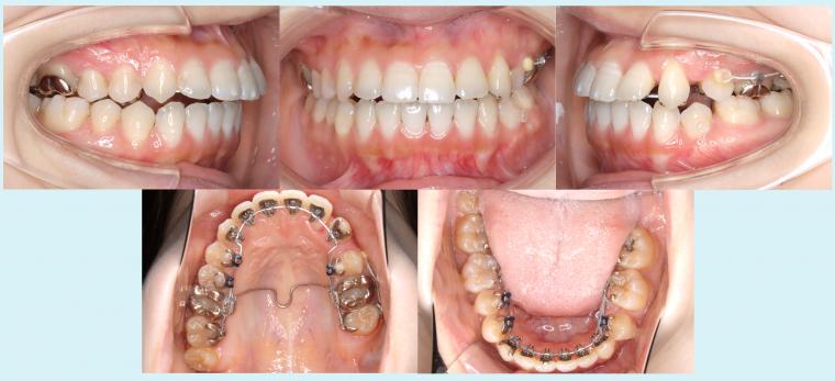 #25　裏側矯正装置で八重歯を治療した症例