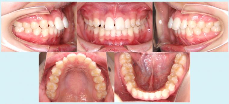 #26　10か月ですきっ歯を治療した症例