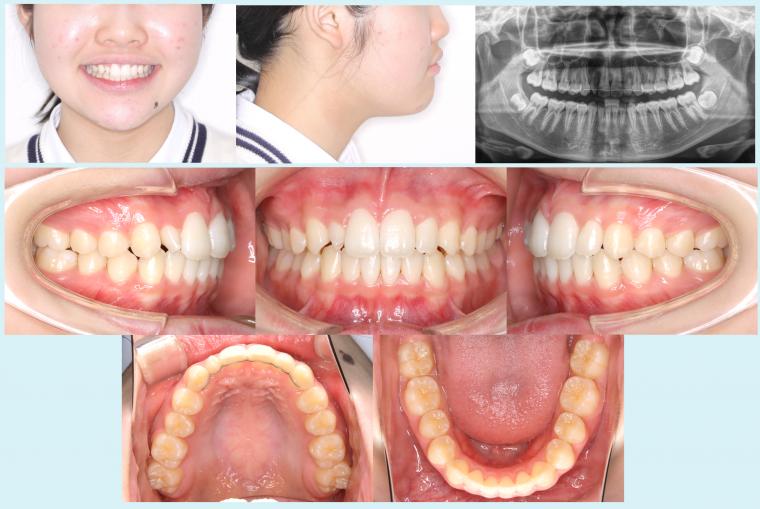 #26　10か月ですきっ歯を治療した症例