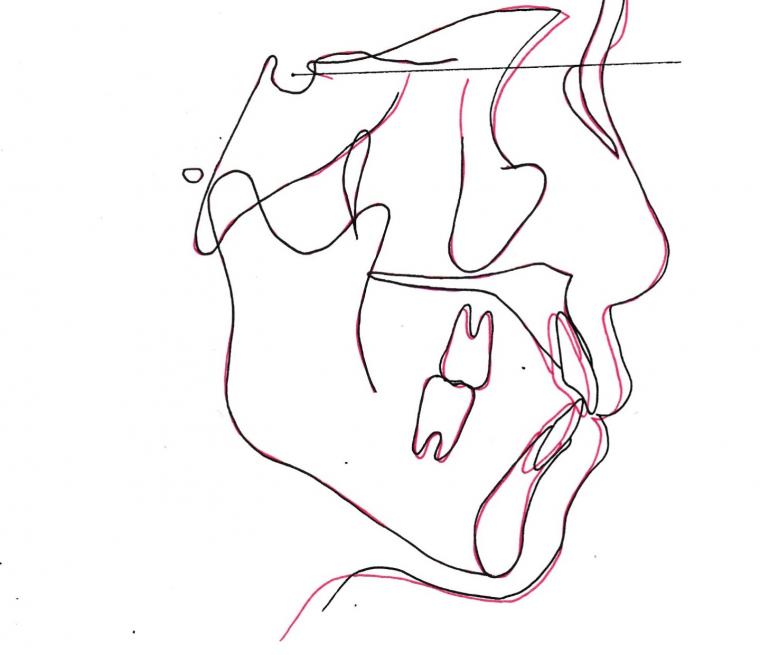＃1　上顎の小臼歯を抜歯して八重歯を治療したフルリンガル症例
