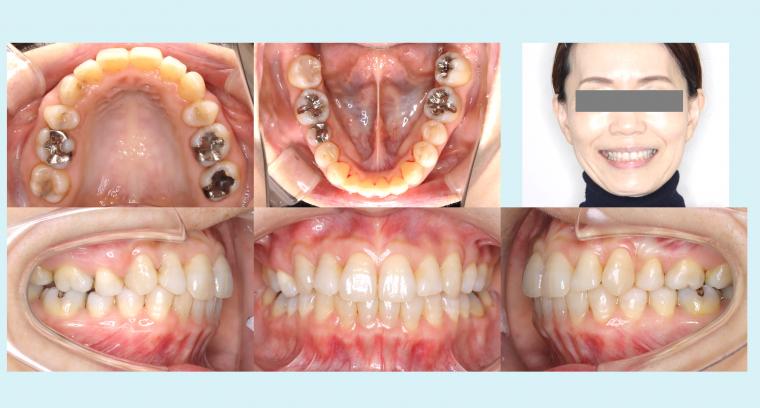 ＃1　上顎の小臼歯を抜歯して八重歯を治療したフルリンガル症例