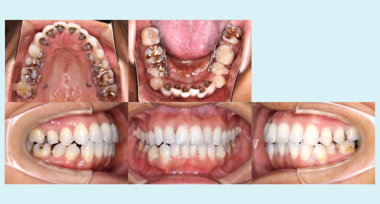 #5　抜歯を行わずに叢生を治療したフルリンガル症例