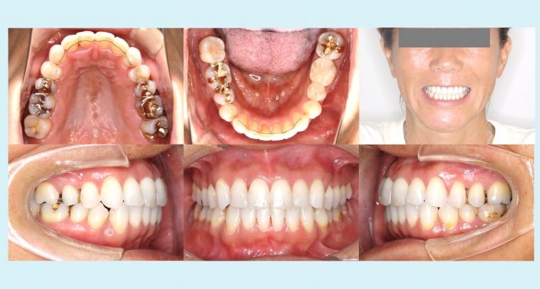 #5　抜歯を行わずに叢生を治療したフルリンガル症例