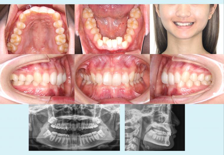 #6　前歯の深いかみ合わせを治療したハーフリンガル症例