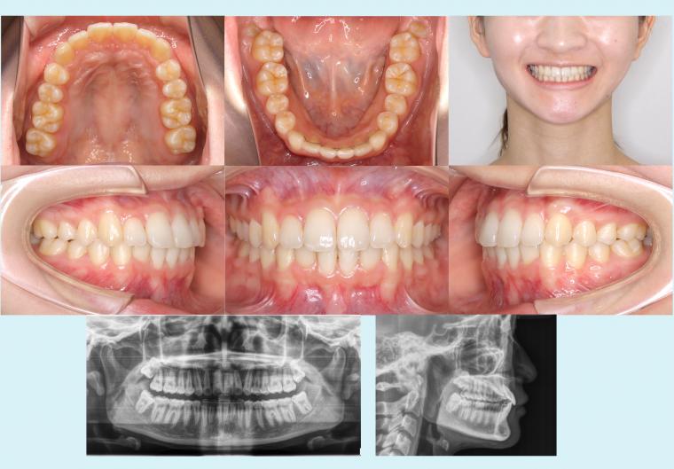 #6　前歯の深いかみ合わせを治療したハーフリンガル症例