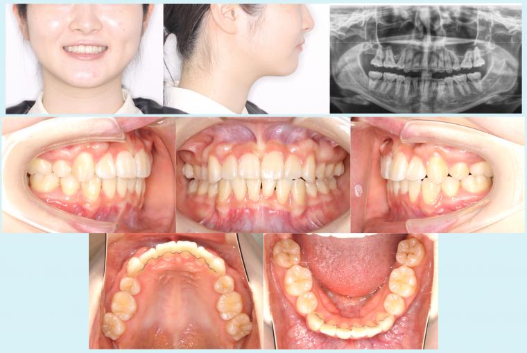 #30　デコボコしている歯並びを治療した症例