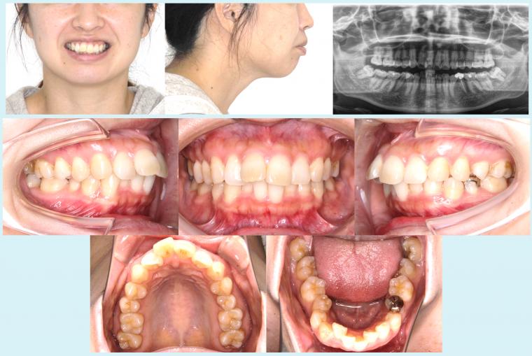 #31　上下顎前突を治療した症例
