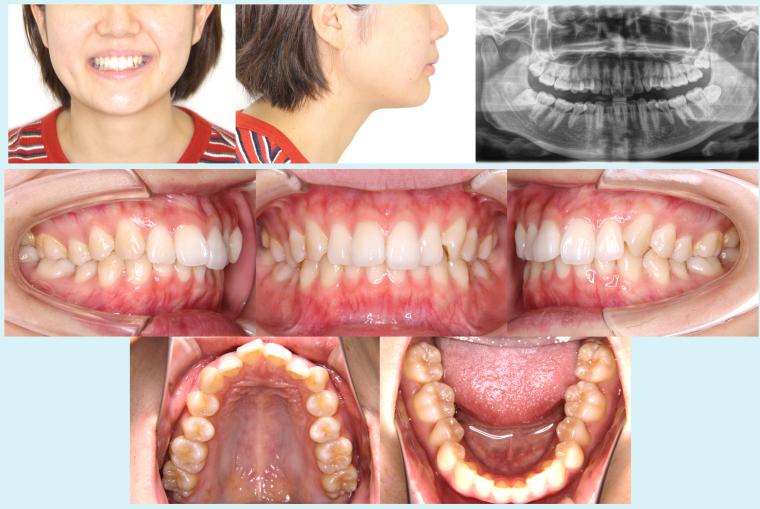 #32　上顎前突を改善した予後2年経過症例
