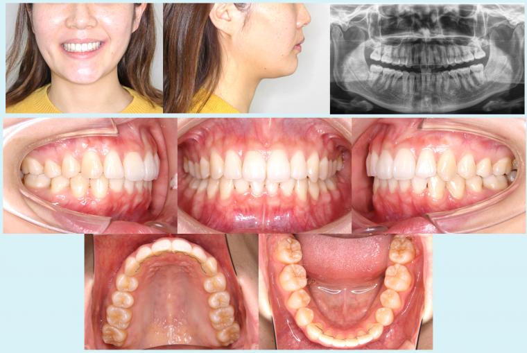 #32　上顎前突を改善した予後2年経過症例