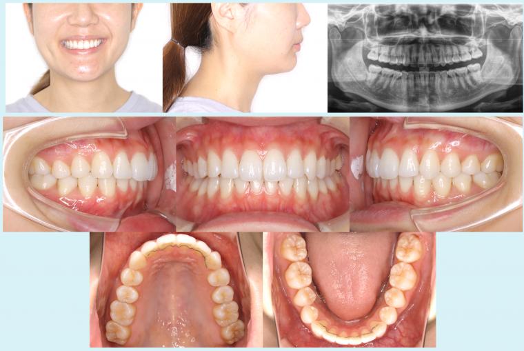 #32　上顎前突を改善した予後2年経過症例