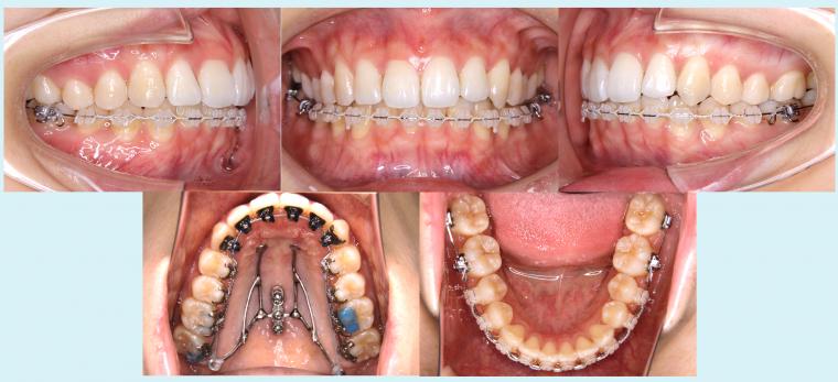 #32　上顎前突を改善した予後2年経過症例