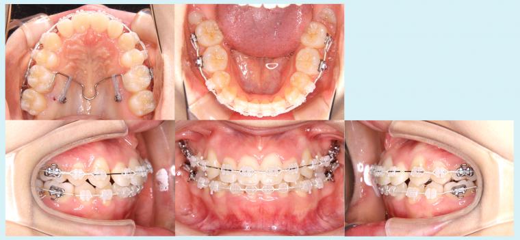 #10　上下4本の小臼歯抜歯を行って治療した症例