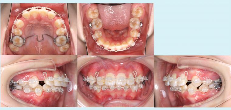 #11　上下小臼歯を4本抜歯して治療した成長期症例